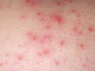 strep skin infection pictures #10