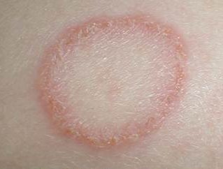 what cause skin infection